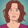 Afhjælpe acne med cystedannelse
