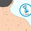 Slip af med acne ar på ryggen