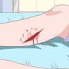 Behandling af cellulite