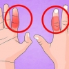 Behandling af en brækket finger