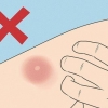 Behandling af et myggestik