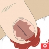 Fjern en splint under din negl