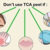 Påføring af en tca peel