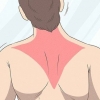 Gendannelse af en trapezius-stamme