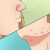 Slip af med acne hurtigt og naturligt