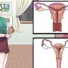 Behandling af vaginale cyster