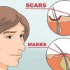 Slip af med acne røde pletter