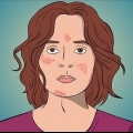 Afhjælpe acne med cystedannelse