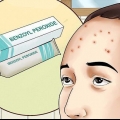 Slip af med acne på din pande