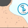 Slip af med acne ar på ryggen
