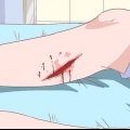 Behandling af cellulite