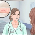 Lindring af symptomerne på spongiotisk dermatitis