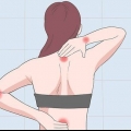 Behandling af en klemt nerve