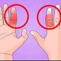 Behandling af en brækket finger