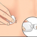 Behandling af en irriteret navlepiercing
