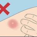 Behandling af et myggestik