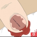 Fjern en splint under din negl