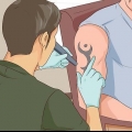 Fjern en tatovering