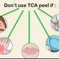 Påføring af en tca peel