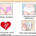 Behandling af en vaginal gærinfektion