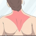 Gendannelse af en trapezius-stamme