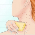 Behandling af folliculitis