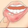Genkender herpes