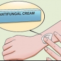Behandl ringorm