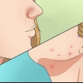 Slip af med acne hurtigt og naturligt