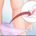 Forebyggelse af vaginal blødning under graviditet
