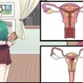 Behandling af vaginale cyster
