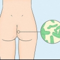 Slip af med acne på dine balder