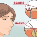 Slip af med acne røde pletter