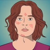 Afhjælpe acne med cystedannelse