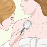 Slip af med acne ar på brystet