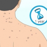 Slip af med acne ar på ryggen
