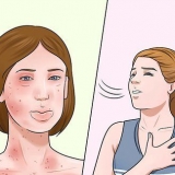 Behandling af allergier