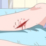 Behandling af cellulite