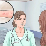 Lindring af symptomerne på spongiotisk dermatitis