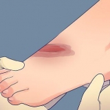 Behandling af dybe snit