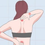 Behandling af en klemt nerve