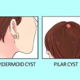 Behandling af en cyste