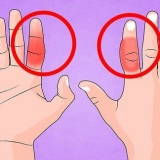 Behandling af en brækket finger