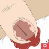 Fjern en splint under din negl