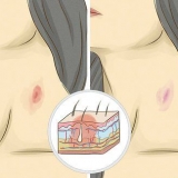 Giv en hickey