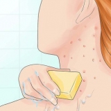 Behandling af folliculitis