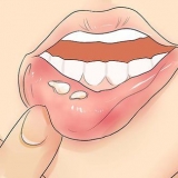 Genkender herpes
