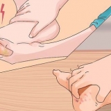 Behandling af trench feet