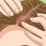Genkender psoriasis i hovedbunden