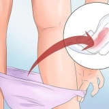 Forebyggelse af vaginal blødning under graviditet